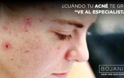 ¿Cuándo Tu Acné Te Grita “Ve Al Especialista”?