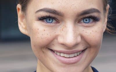 Pecas: Una Señal De Mayor Sensibilidad A Los Rayos Solares