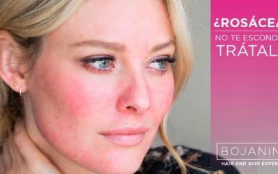 ¿Rosácea?, No Te Escondas, Trátala