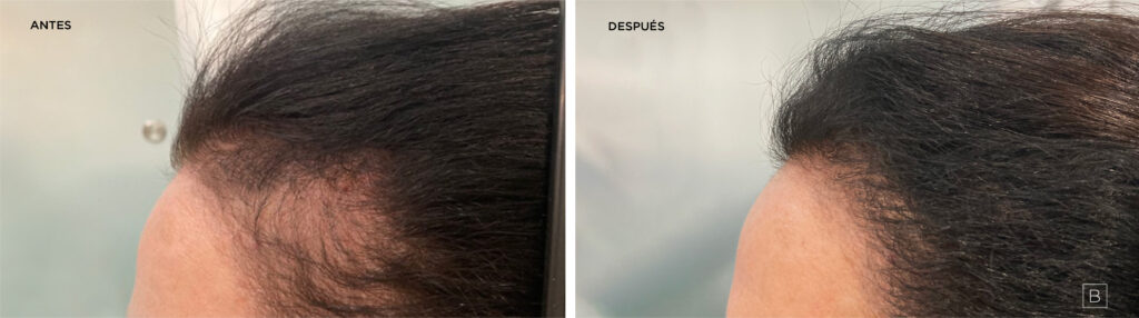 Implante Capilar en Bogotá Colombia con Bojanini Experts