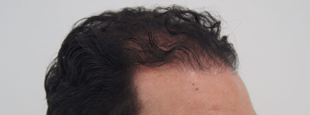 Implante Capilar en Bogotá con Bojanini Experts