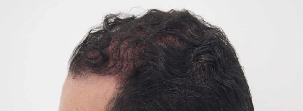 Implante Capilar en Colombia con Bojanini Experts