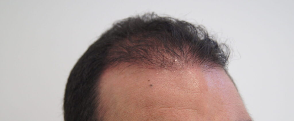 Implante Capilar en Bogotá con Bojanini Experts