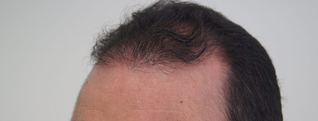 Implante Capilar en Bogotá Colombia 