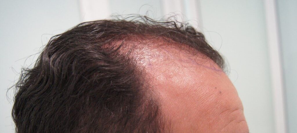 Implante Capilar en Bogotá con Bojanini Experts