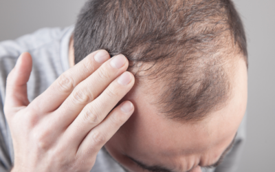 Implante Capilar: Los 5 temores más comunes