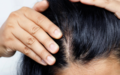 Caída del cabello ¿Cómo identificar si es normal o es alopecia?