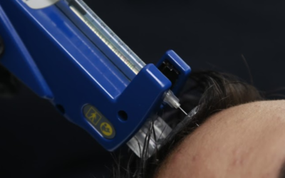 Tratamientos para la caída del cabello – ¿Mesoterapia o Plasma Capilar?