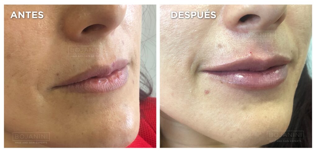 Botox o Ácido Hialurónico