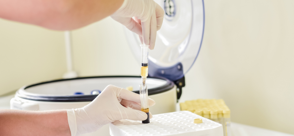 tratamiento caída del cabello plasma capilar