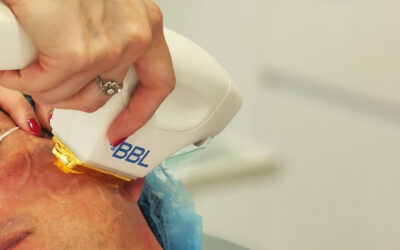 Tratamientos Láser para Manchas en la Piel:La Innovación Moxi y BBL HERO